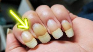 pourquoi mes ongles sont jaunes