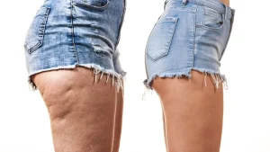 10 astuces pour éliminer complètement la cellulite