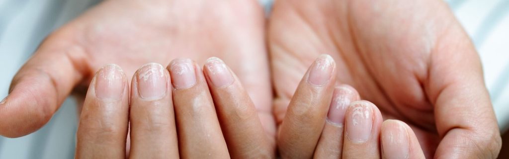 les causes les plus courantes des ongles qui se dédoublent