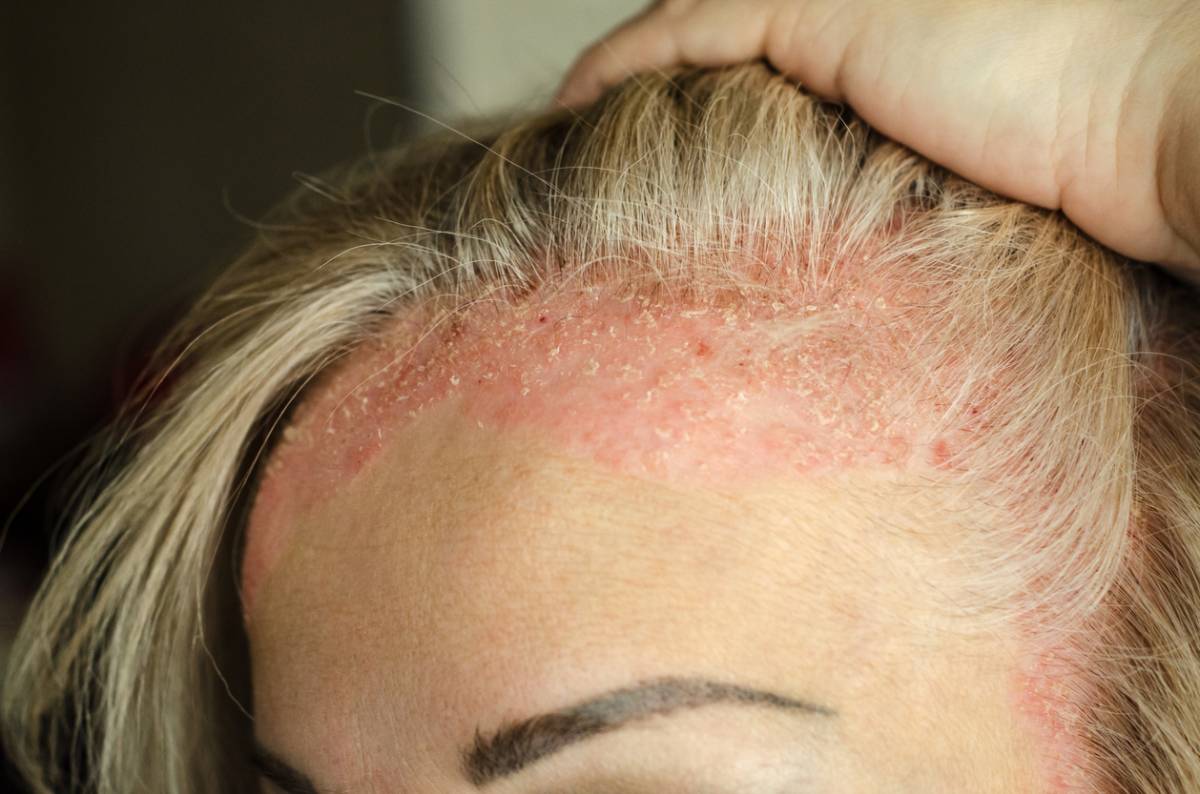 Psoriasis du cuir chevelu : soulager squames et démangeaisons